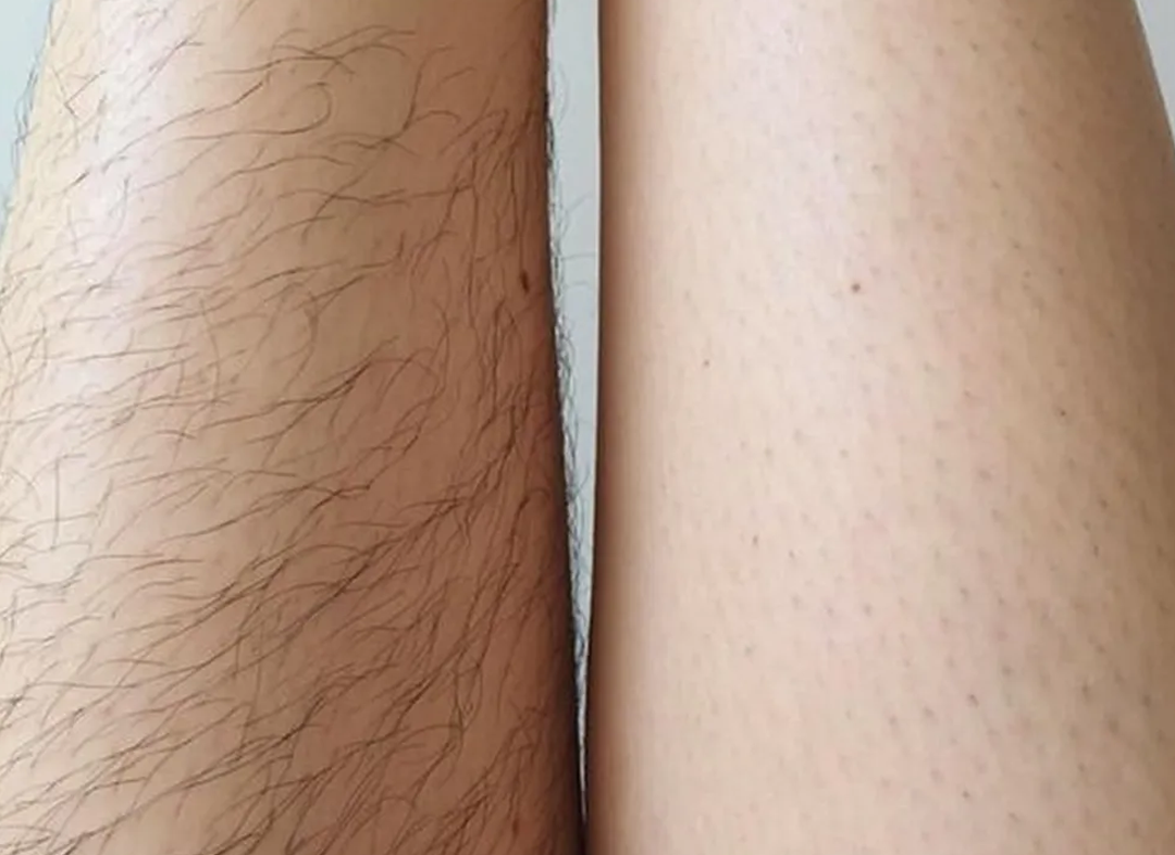 Depilação a laser em Buritis